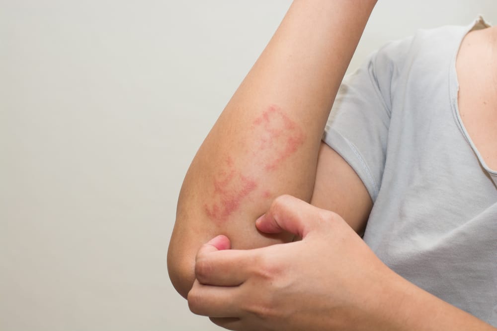 Dermatite da sudore: come si cura con i rimedi naturali
