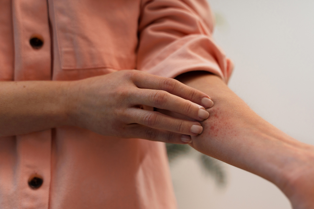 allergia al nichel prurito e rossore per dermatite da contatto